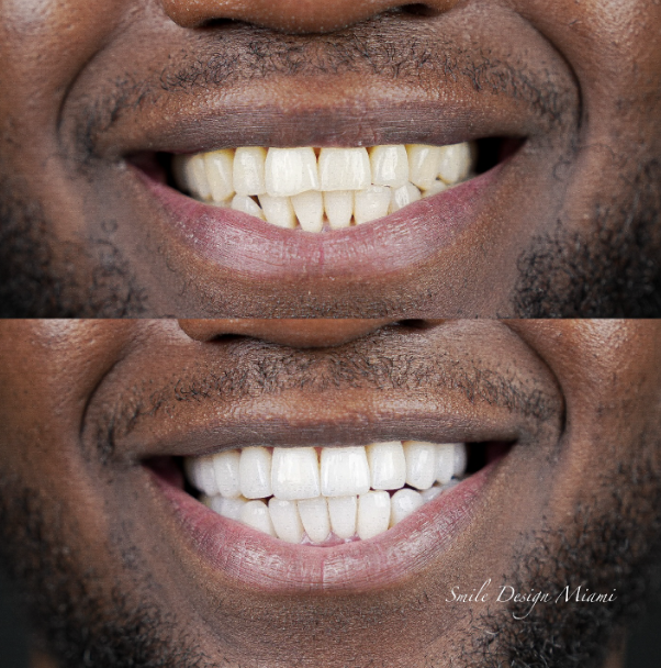 Complete guide to veneers in Miami